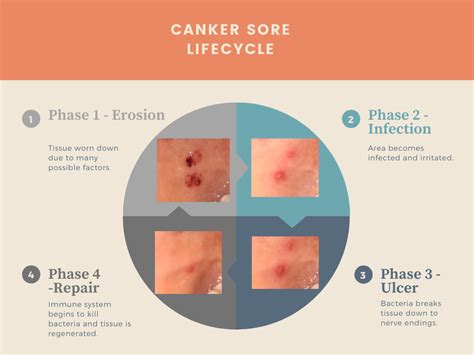 Mouth Ulcer / Canker Sore Diagram — Canker Shield