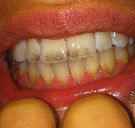 How I Remineralized My Teeth – Extreme Health Radio