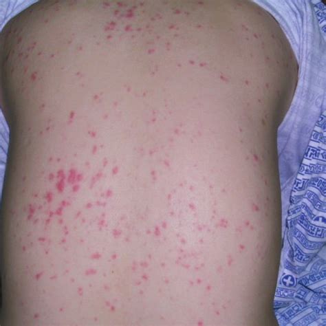 Rash on the back of the patient. Diffuse erythematous papular lesions ...