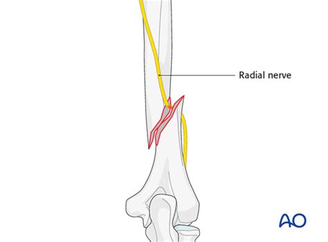 Fracture Humerus And Radial Nerve Palsy —, 53% OFF