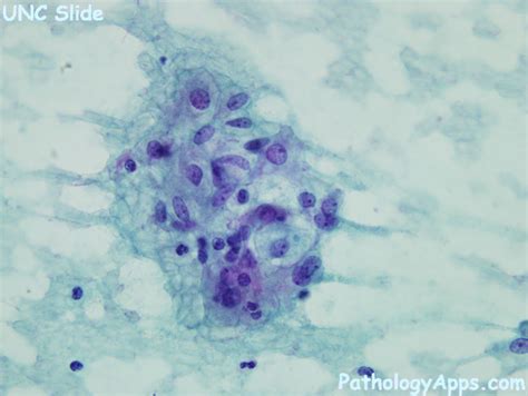 malakoplakia cytology