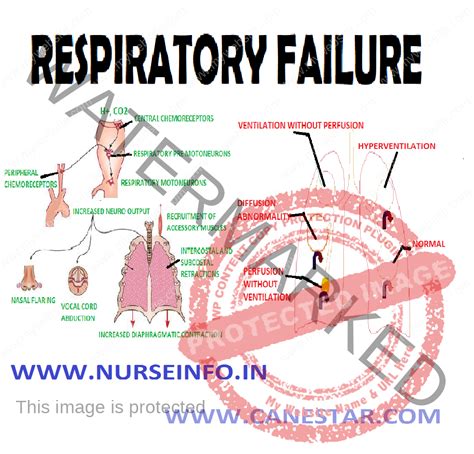 RESPIRATORY FAILURE - Nurse Info