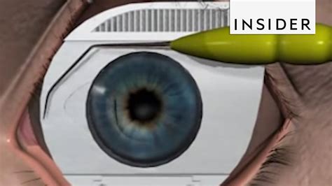 How Does LASIK Correct Vision? | Videos