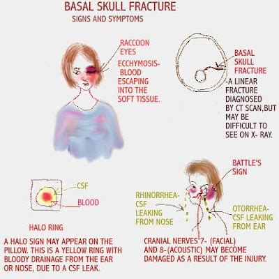 Dear Nurses: SIMPLIFYING BASAL SKULL FRACTURE