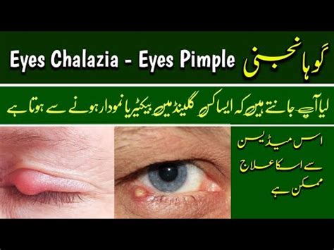 Eyes Chalazia - Eyes Pimple - Eye Chalazion گوہانجی || Symptoms, Causes ...