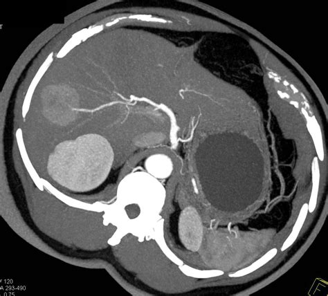 Focal Nodular Hyperplasia (FNH) - Liver Case Studies - CTisus CT Scanning