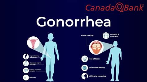 Gonorrhea | DenverFerguson