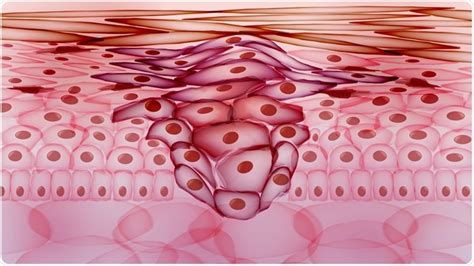 Metastasis Process