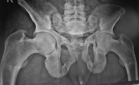 Plain X-ray pelvis anteroposterior view showing complete healing of ...