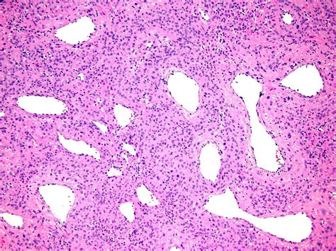 Pathology Outlines - Myopericytoma / myofibroma