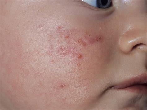 Childhood rashes, skin conditions and infections: photos - BabyCenter