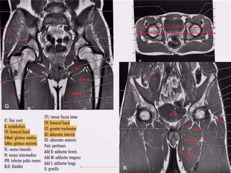 Pelvis Muscles Mri Anatomy Mri Anatomy Of Hip Joint F - vrogue.co