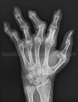 Broken Index Finger X Ray