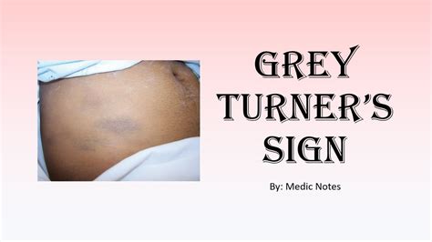 Grey Turner Sign