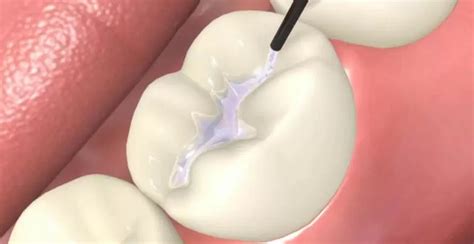 What are Dental Sealants & How Dental Sealants Procedure Work