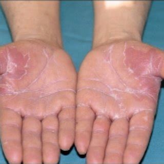 Palmar edema and erythema, with fine desquamation (palmar plantar... | Download Scientific Diagram