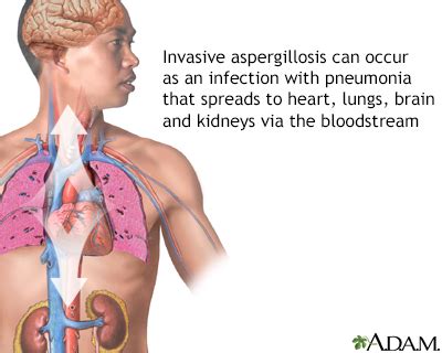 Aspergillosis Symptoms, Doctors, Treatments, Advances & More | MediFind