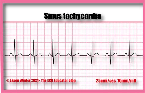 Sinus Arrhythmia Rhythm Strip