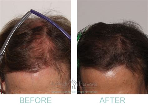 Low Level Laser Therapy For Hair Loss Wellesley & Boston, MA - Medi Tresse