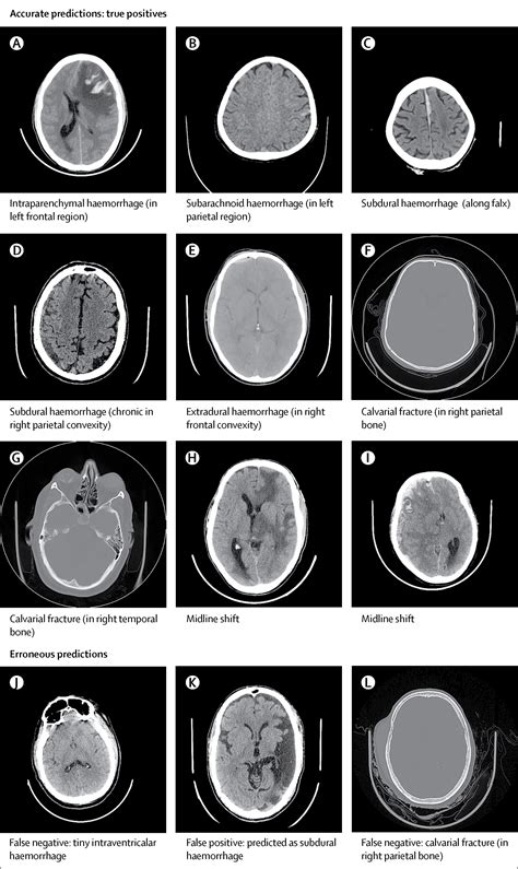 Brain Ct Scan Report Sample Pdf - barebonestory