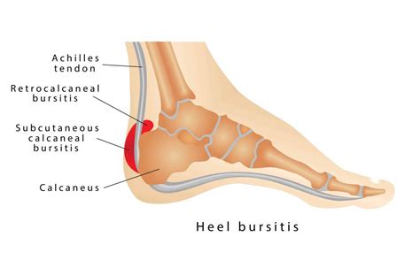 Common Conditions Causing Heel Pain Health Plus | atelier-yuwa.ciao.jp