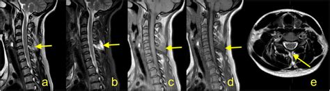 The cervical spine magnetic resonance imaging protocol used at the ...