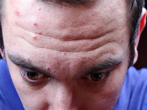 Ways To Prevent Forehead Wrinkles - Boldsky.com