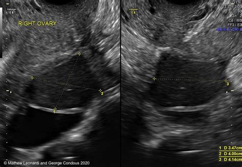 Endometriosis Transvaginal Ultrasound