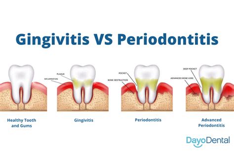 Gingivitis vs Periodontitis: Stages of Gum Diseases Explained