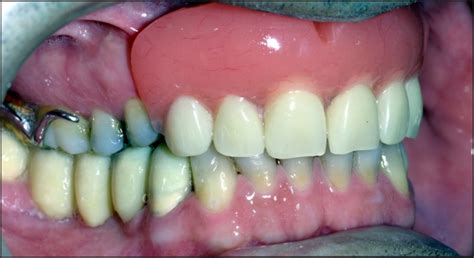 Provisional maxillary removable partial denture. | Download Scientific ...