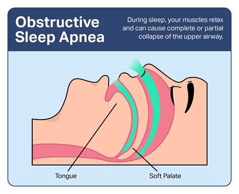 Obstructive Sleep Apnea: Symptoms, Causes, and Treatments