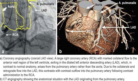 ALCAPA Syndrome in Adulthood—a Rare Coronary Anomaly (21.08.2023)