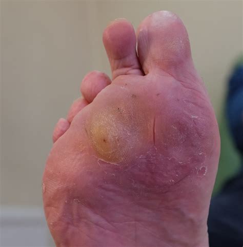 How arthritis can affect our feet - Feel Your Feet