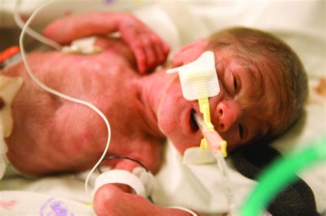 Extremely preterm infants fare better with corticosteroid and magnesium combo | MDedge ObGyn