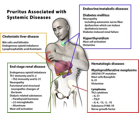 Itching as a systemic disease - Journal of Allergy and Clinical Immunology