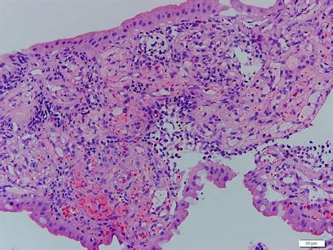 Pathology Outlines - Portal hypertensive gastropathy