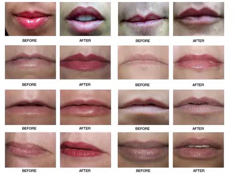 Saved Photo | Botox fillers, Lip fillers, Lipstick designs