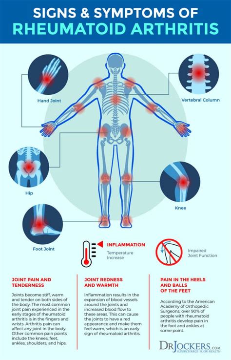 Arthritis Flare Up Treatment at Ronald Wallace blog