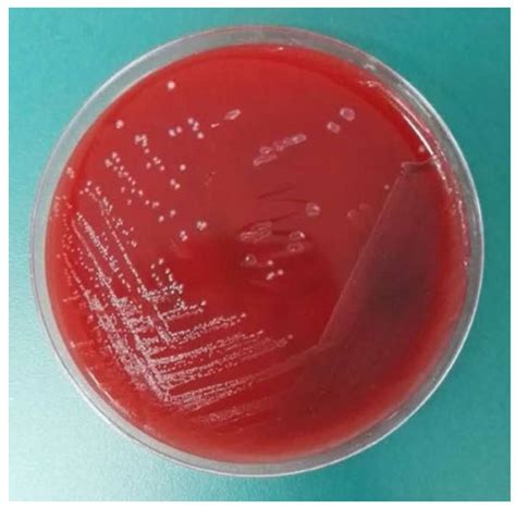 Streptococcus gallolyticus meningocephalitis in adults: the first case report in China