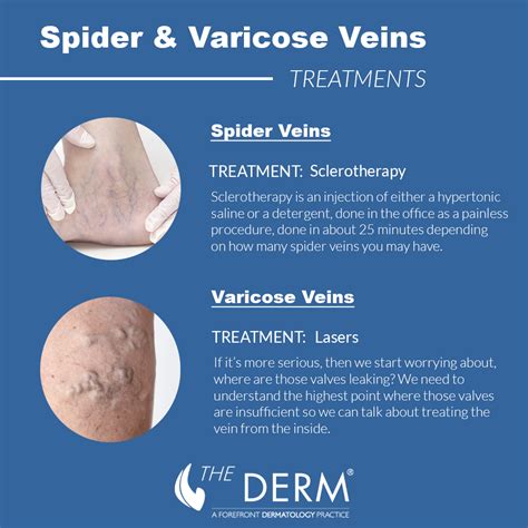 Spider Veins Treatment