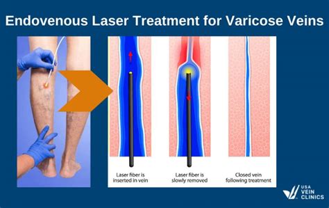 Varicose Vein Removal And Surgery | USA Vein Clinics