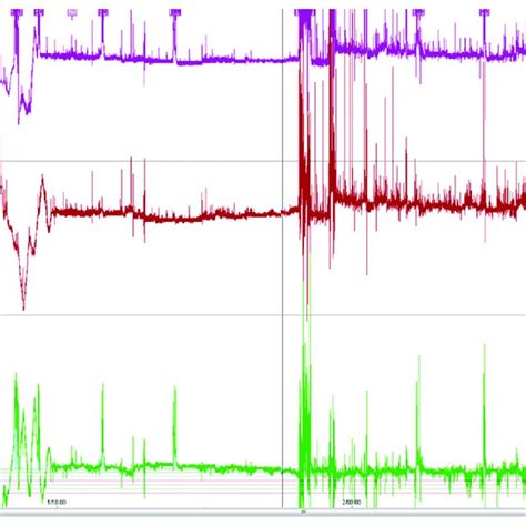 (PDF) Measurement of Urinary Bladder Pressure: A Comparison of Methods