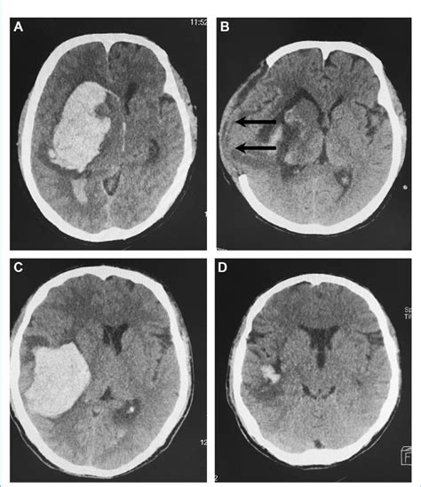 The Basal Ganglia Hematoma Was Evacuated By Transcortical Transtemporal | Porn Sex Picture