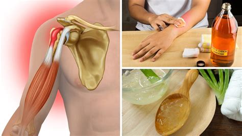 6 Home Remedies for Tendinitis That Actually Work (Tendonitis) - YouTube