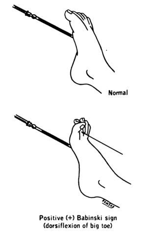 Plantar reflex - Wikipedia, the free encyclopedia | Plantar reflex, Plantar fasciitis, Spinal injury