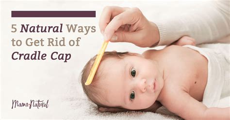 Cradle Cap: What Is It? And Do You Need to Worry About It?