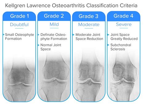 Osteoarthritis Stages Knee