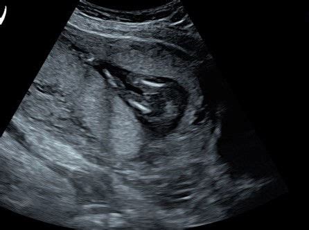 A gender reveal ultrasound with an extra surprise!