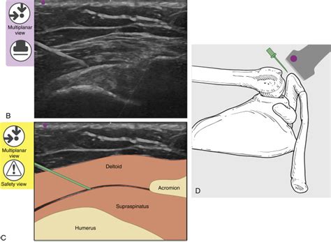 Shoulder/Subacromial–Subdeltoid Bursa Injection—Lateral Approach: Ultrasound Guidance ...