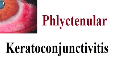 phlyctenular Keratoconjunctivitis - YouTube